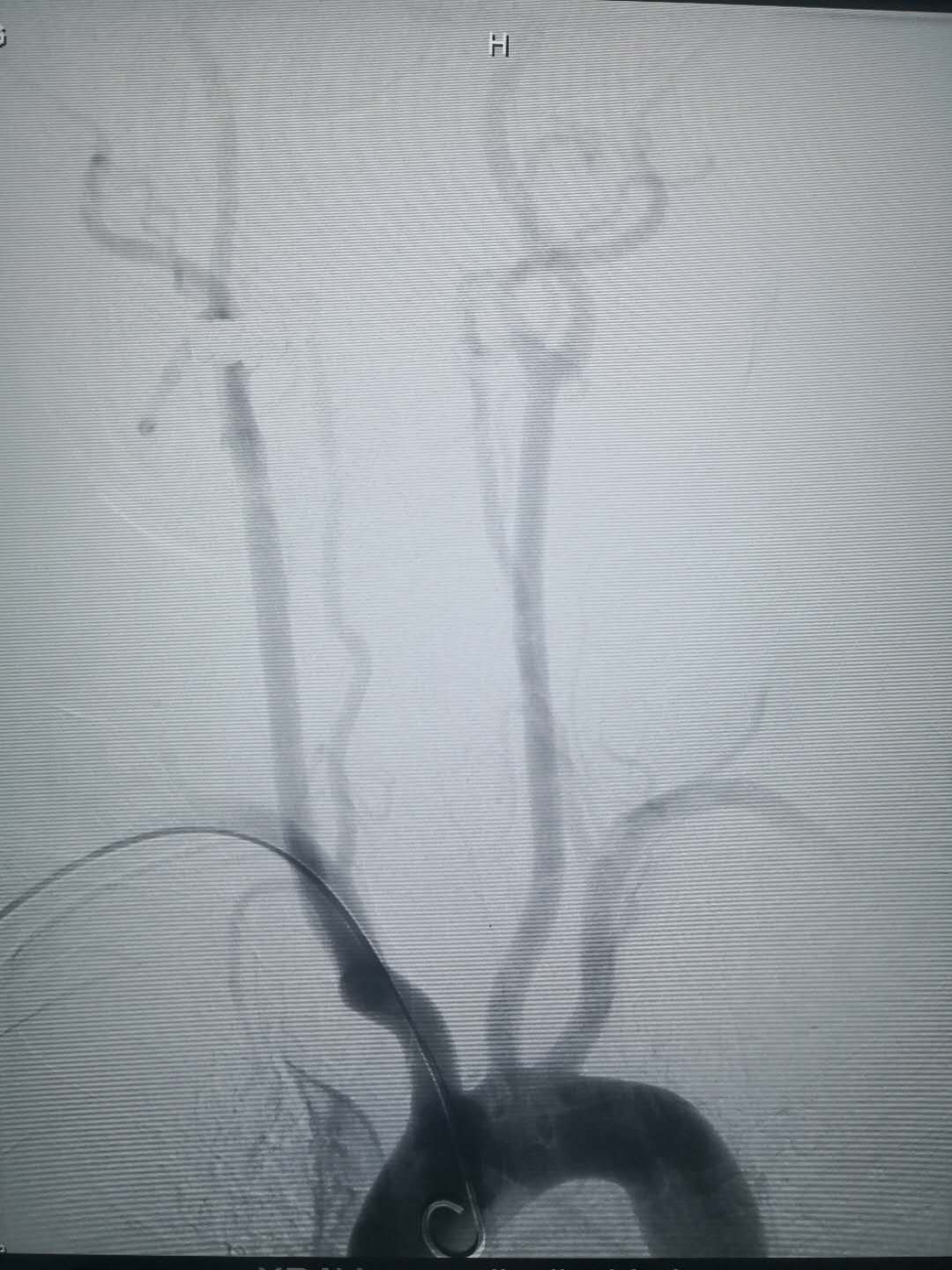 我院成功開展經橈動脈穿刺行全腦血管造影術