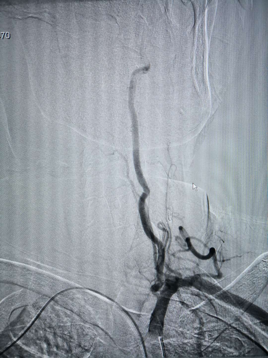 我院成功開展經橈動脈穿刺行全腦血管造影術