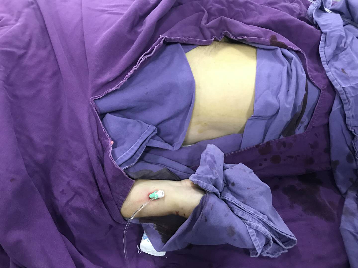 我院成功開展經橈動脈穿刺行全腦血管造影術