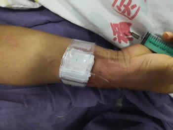 我院成功開展經橈動脈穿刺行全腦血管造影術