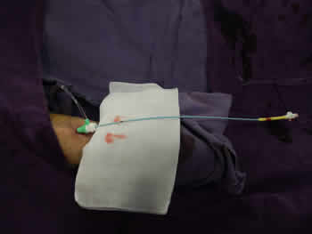 我院成功開展經橈動脈穿刺行全腦血管造影術