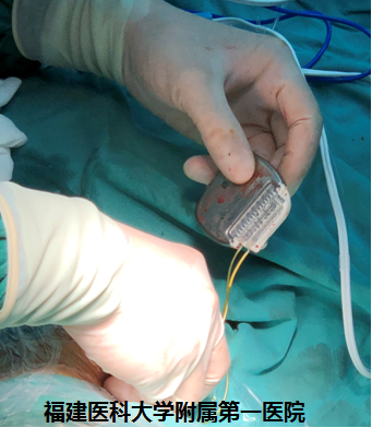 疼痛到什么部位，手術(shù)就控制到什么部位 ——我院神經(jīng)外科林章雅教授帶領(lǐng)團(tuán)隊(duì)精準(zhǔn)施治脊髓損傷后頑固性疼痛