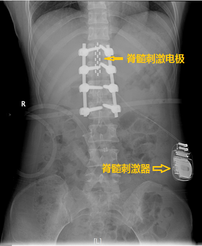 疼痛到什么部位，手術(shù)就控制到什么部位 ——我院神經(jīng)外科林章雅教授帶領(lǐng)團(tuán)隊(duì)精準(zhǔn)施治脊髓損傷后頑固性疼痛