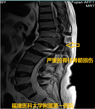疼痛到什么部位，手術(shù)就控制到什么部位 ——我院神經(jīng)外科林章雅教授帶領(lǐng)團(tuán)隊(duì)精準(zhǔn)施治脊髓損傷后頑固性疼痛