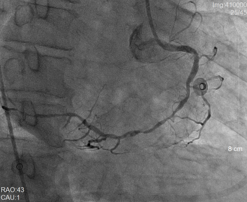 我院多學科聯合成功救治一名右位心合并心肌梗死患者