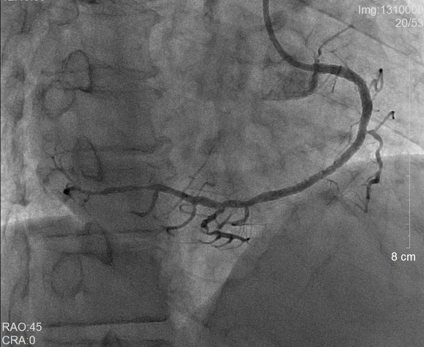我院多學科聯合成功救治一名右位心合并心肌梗死患者