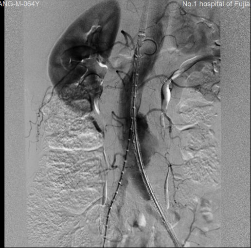 我院多學(xué)科協(xié)作成功搶救多名主動(dòng)脈瘤破裂患者
