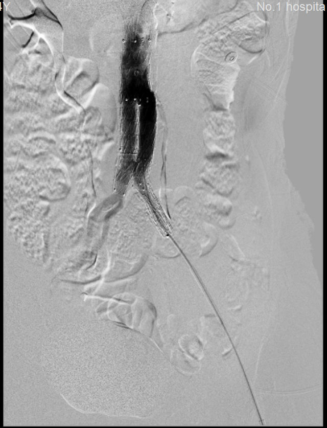 我院多學(xué)科協(xié)作成功搶救多名主動(dòng)脈瘤破裂患者