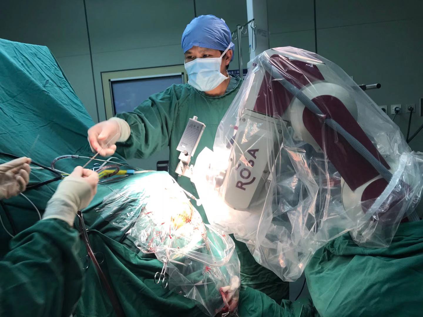 全國首例！我院利用國際新技術(shù)ROSA機(jī)器人 植入丘腦前核腦起搏器電極治療癲癇