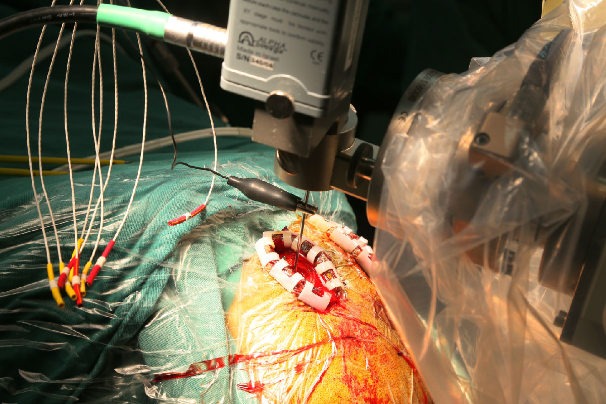 全國首例！我院利用國際新技術(shù)ROSA機(jī)器人 植入丘腦前核腦起搏器電極治療癲癇