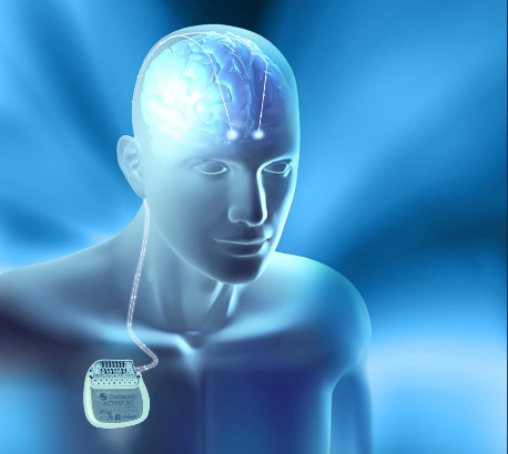 全國首例！我院利用國際新技術(shù)ROSA機(jī)器人 植入丘腦前核腦起搏器電極治療癲癇