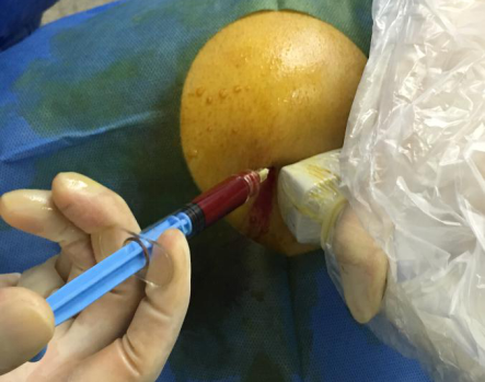 人體自帶的神奇修復血漿PRP ——緩解關節疼痛，修復肌腱損傷，加速創面愈合