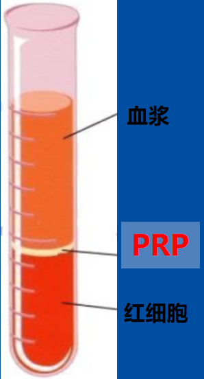 人體自帶的神奇修復血漿PRP ——緩解關節疼痛，修復肌腱損傷，加速創面愈合