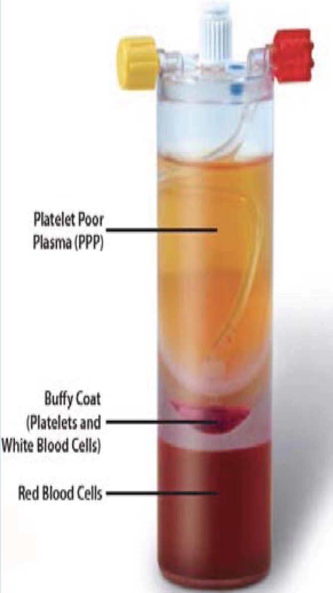 人體自帶的神奇修復血漿PRP ——緩解關節疼痛，修復肌腱損傷，加速創面愈合