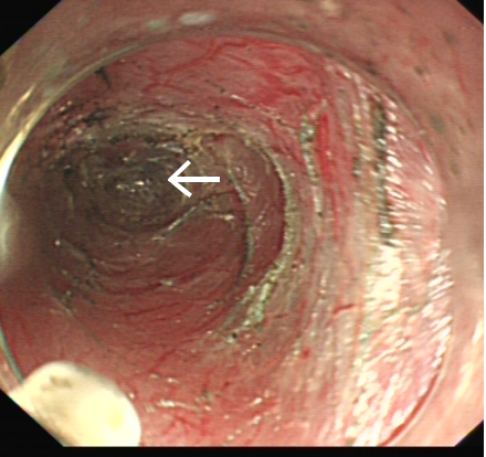 一根“流浪”的魚(yú)刺，一場(chǎng)多學(xué)科協(xié)作的搜尋 ——我院采用隧道內(nèi)鏡技術(shù)完成食管黏膜下異物探查