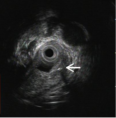 一根“流浪”的魚(yú)刺，一場(chǎng)多學(xué)科協(xié)作的搜尋 ——我院采用隧道內(nèi)鏡技術(shù)完成食管黏膜下異物探查