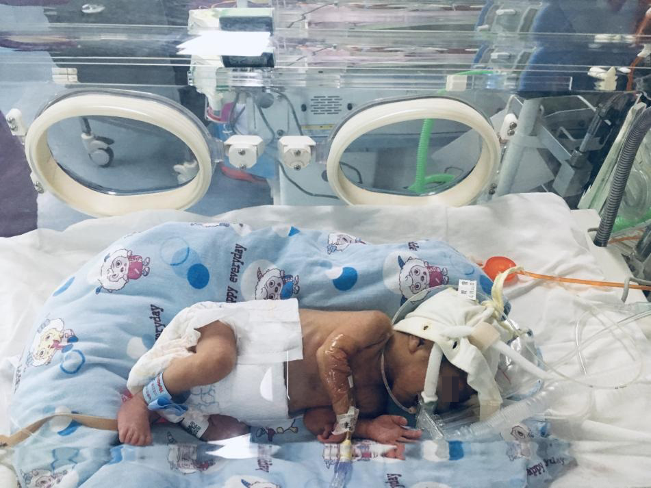 龍鳳胎早產生命垂?！爸B巢”守護 兩個寶寶都只有1公斤多；經過兩周多全力搶救，情況好轉， 目前體重增至1.8公斤左右