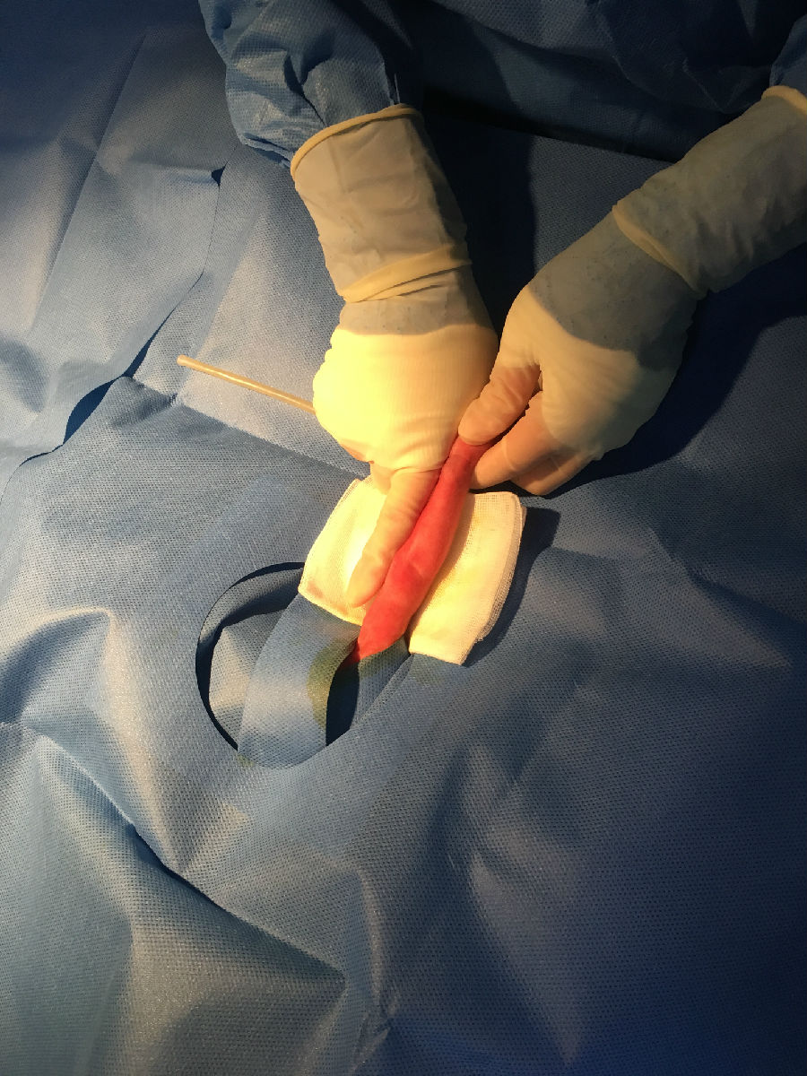 龍鳳胎早產生命垂危“筑鳥巢”守護 兩個寶寶都只有1公斤多；經過兩周多全力搶救，情況好轉， 目前體重增至1.8公斤左右