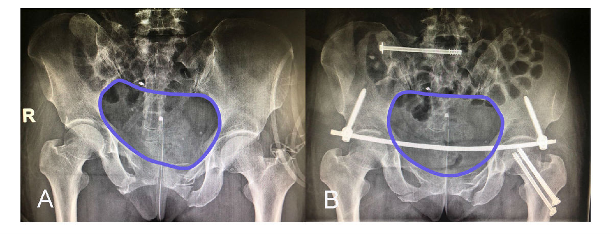 Starr架復(fù)位系統(tǒng)“暗箱操縱”巧治骨盆骨折
