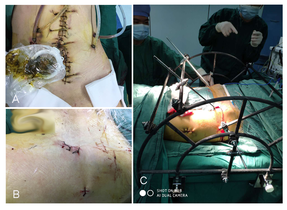 Starr架復(fù)位系統(tǒng)“暗箱操縱”巧治骨盆骨折