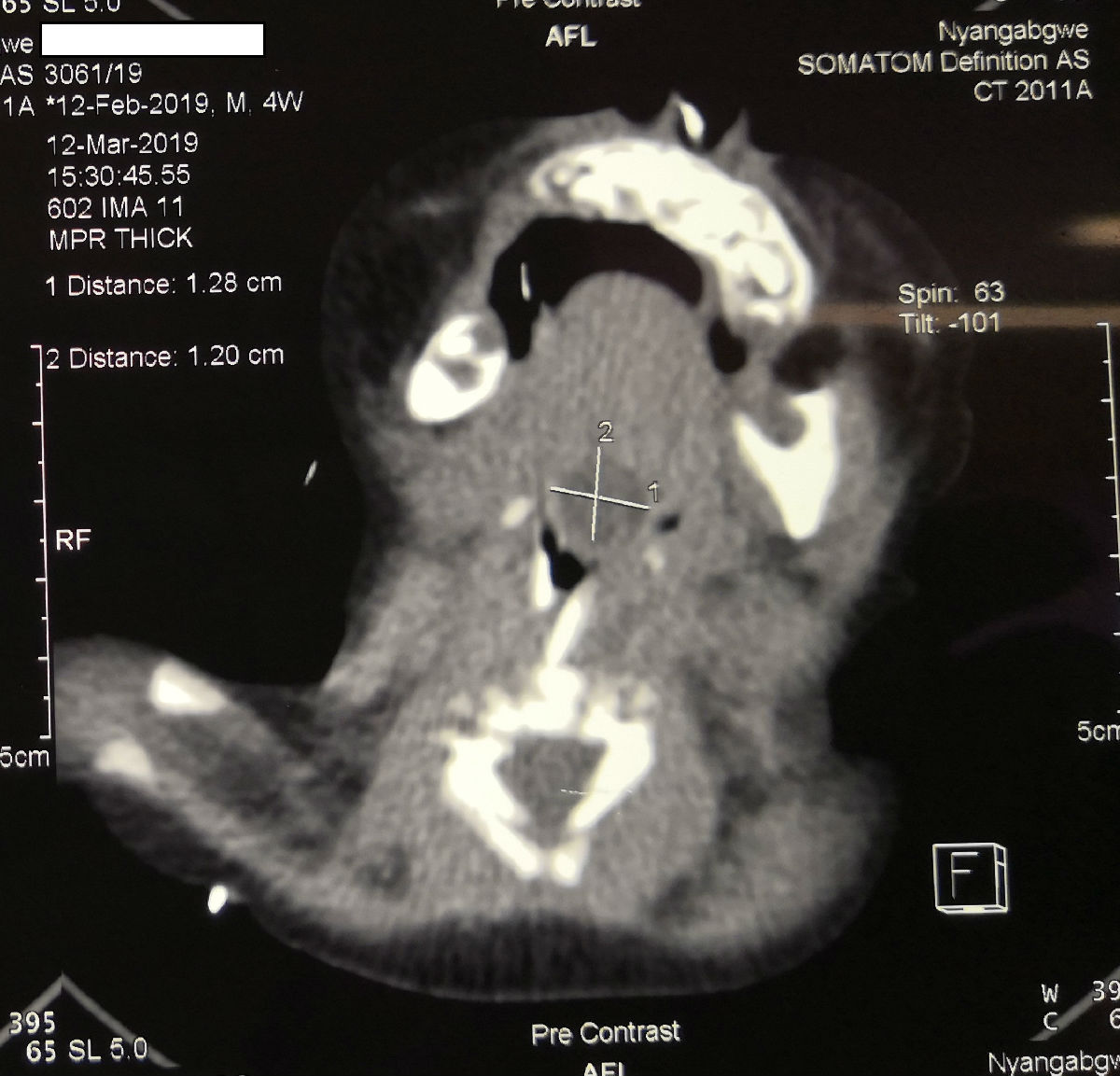 中央電視臺(tái)《華人世界》報(bào)道我院援博隊(duì)員陳希杭先進(jìn)事跡 ——自制手術(shù)器械幫助當(dāng)?shù)貗雰呵谐喔夷[