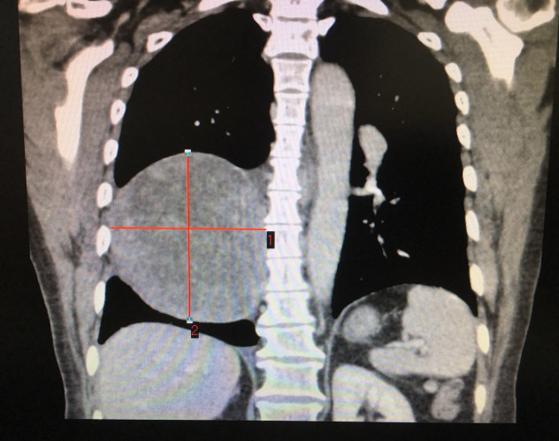 胸外科“拆彈”專家再拆除重磅“炸彈” 胸外科“拆彈”專家再拆除重磅“炸彈”