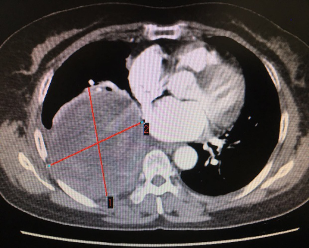 胸外科“拆彈”專家再拆除重磅“炸彈” 胸外科“拆彈”專家再拆除重磅“炸彈”