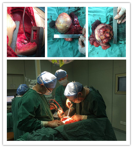 胸外科“拆彈”專家再拆除重磅“炸彈” 胸外科“拆彈”專家再拆除重磅“炸彈”