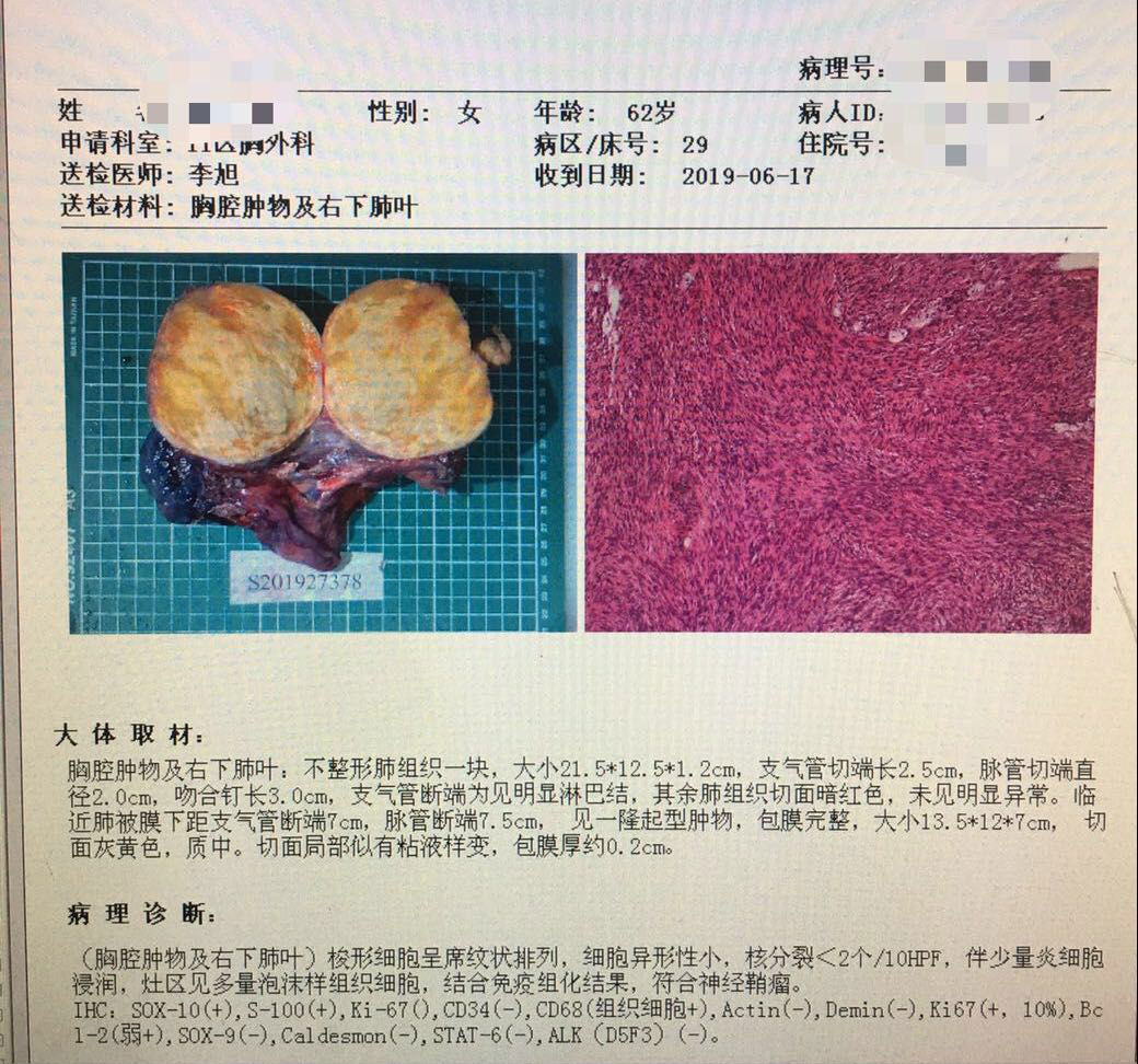 胸外科“拆彈”專家再拆除重磅“炸彈” 胸外科“拆彈”專家再拆除重磅“炸彈”