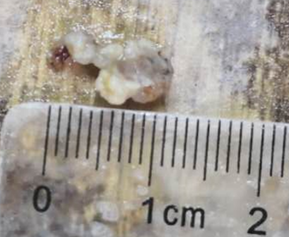 我院援寧隊(duì)員鄭小斌聯(lián)手當(dāng)?shù)蒯t(yī)院神經(jīng)脊柱外科完成高難度脊髓髓內(nèi)血管性腫瘤切除手術(shù)