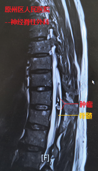 我院援寧隊員鄭小斌聯手當地醫院 完成高級別脊髓內血管性腫瘤切除手術 我院援寧隊員鄭小斌聯手當地醫院 完成高級別脊髓內血管性腫瘤切除手術