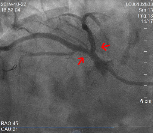 92歲罕見“鏡面人”心肌梗死 我院心內科團隊成功為其完成左主干分叉病變雙支架治療