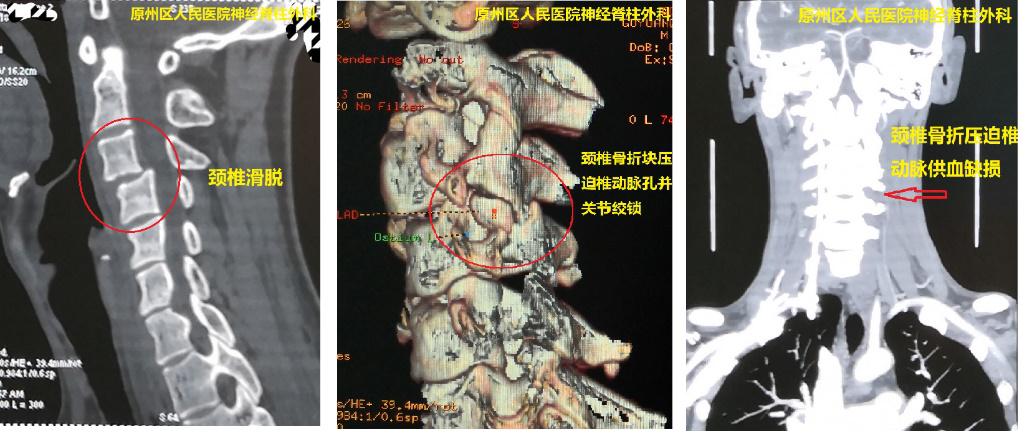 精準“制導”  我院援寧隊員鄭小斌協助當地醫院神經脊柱外科實施頸椎“椎弓根置釘”術成功救治頸椎骨折滑脫患者