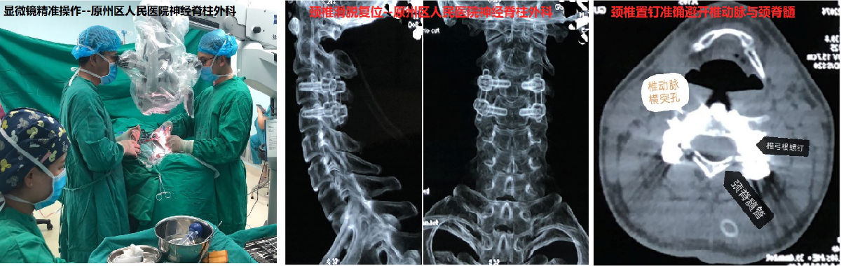 精準“制導”  我院援寧隊員鄭小斌協助當地醫院神經脊柱外科實施頸椎“椎弓根置釘”術成功救治頸椎骨折滑脫患者