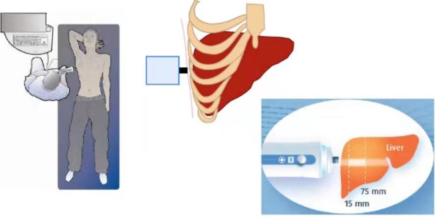 我院引進無創肝臟彈性及脂肪肝定量檢測技術