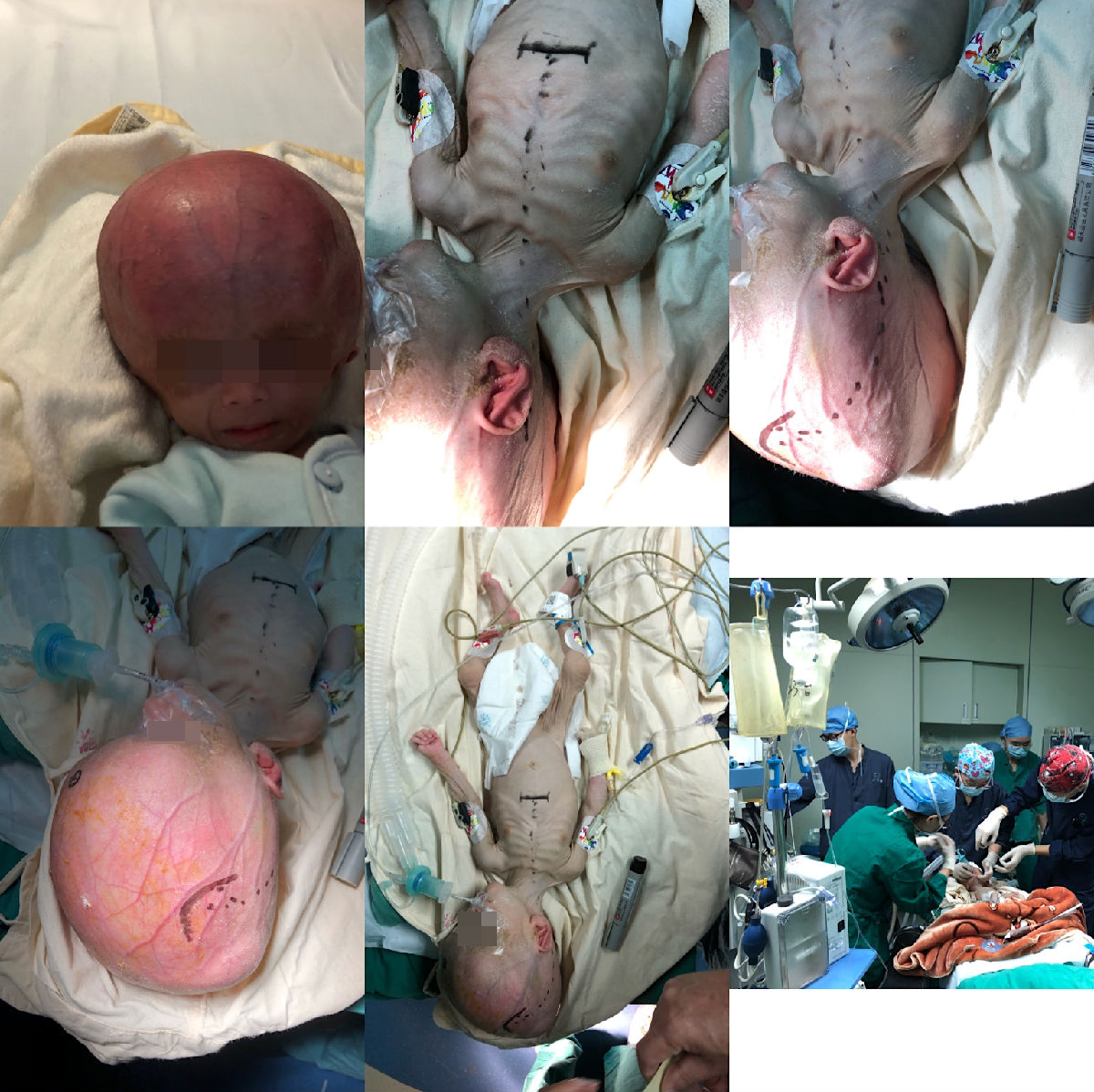 “大頭大頭”下雨不愁，卻愁壞了這家子 —— 神外醫護齊上陣，圓“大頭”娃娃健康夢