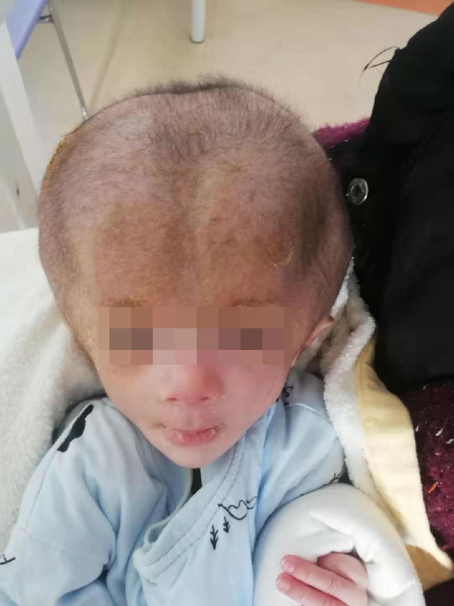 “大頭大頭”下雨不愁，卻愁壞了這家子 —— 神外醫護齊上陣，圓“大頭”娃娃健康夢