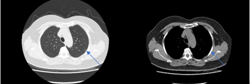 免插管免禁食！我院胸外科肺結(jié)節(jié)切除手術(shù)進(jìn)入微創(chuàng)新時(shí)代