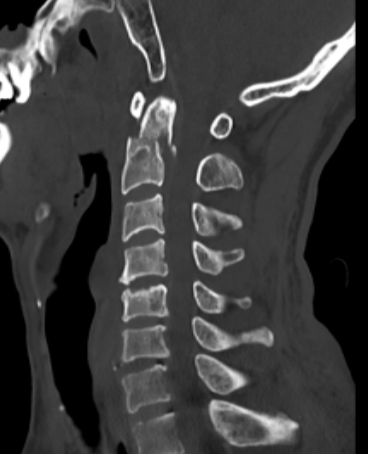 福建醫(yī)科大學(xué)附一泉港總醫(yī)院完成泉港地區(qū)首例寰樞椎骨折后路切開復(fù)位內(nèi)固定聯(lián)合頸前路多節(jié)段頸椎手術(shù) 福建醫(yī)科大學(xué)附一泉港總醫(yī)院完成泉港地區(qū)首例寰樞椎骨折后路切開復(fù)位內(nèi)固定聯(lián)合頸前路多節(jié)段頸椎手術(shù)