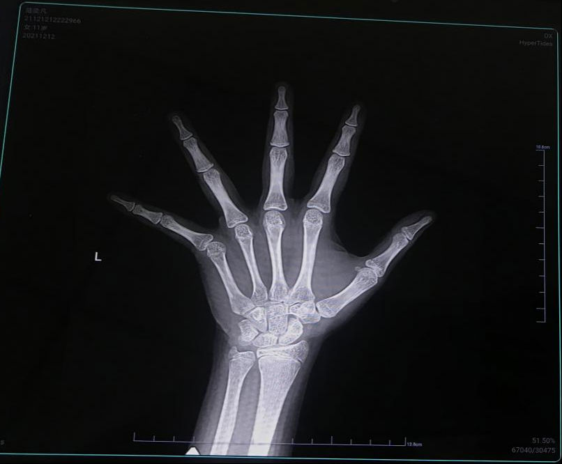 我院兒童生長發育?？崎T診 免費為200多名孩子測骨齡