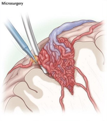 年輕人常見的腦出血原因-說說腦血管畸形