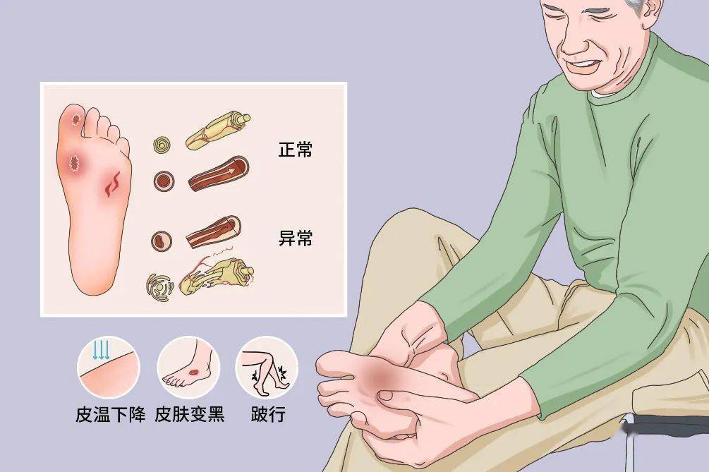 科普促健康 攜手向未來 ——我院血管外科黨支部開展知“足”常樂科普義診活動